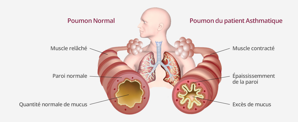 Pathologie de l’asthme